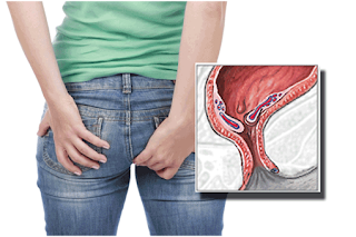 Obat wasir berdarah secara alami, obat wasir yang ampuh apa ya, jual obat buat penyakit wasir di sidenreng, jual obat untuk penyakit ambeien di lasusua, nama obat penyakit wasir ampuh, cara mengobati wasir atau ambeien pada wanita hamil, penyakit ambeyen dalam, mengobati wasir atau ambeien stadium 2, obat buat penyakit ambeien alamiah, obat ambeyen lampung, jual obat buat penyakit wasir di pangkalan bun